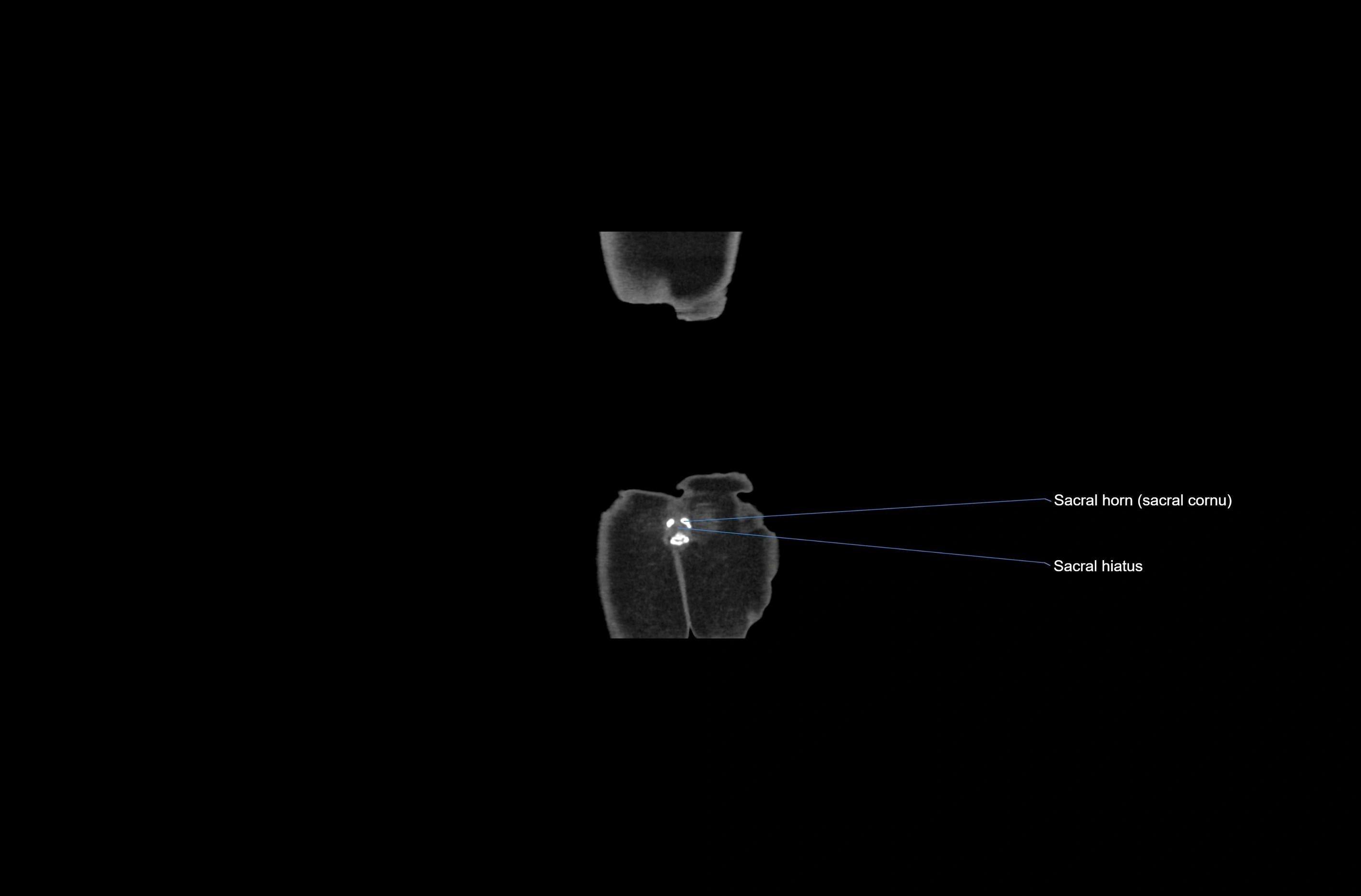 CT abdomen coronal cross sectional anatomy labelled radiology image-00086.webp